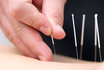 Akupunktur - Schnupper Therapie 1
